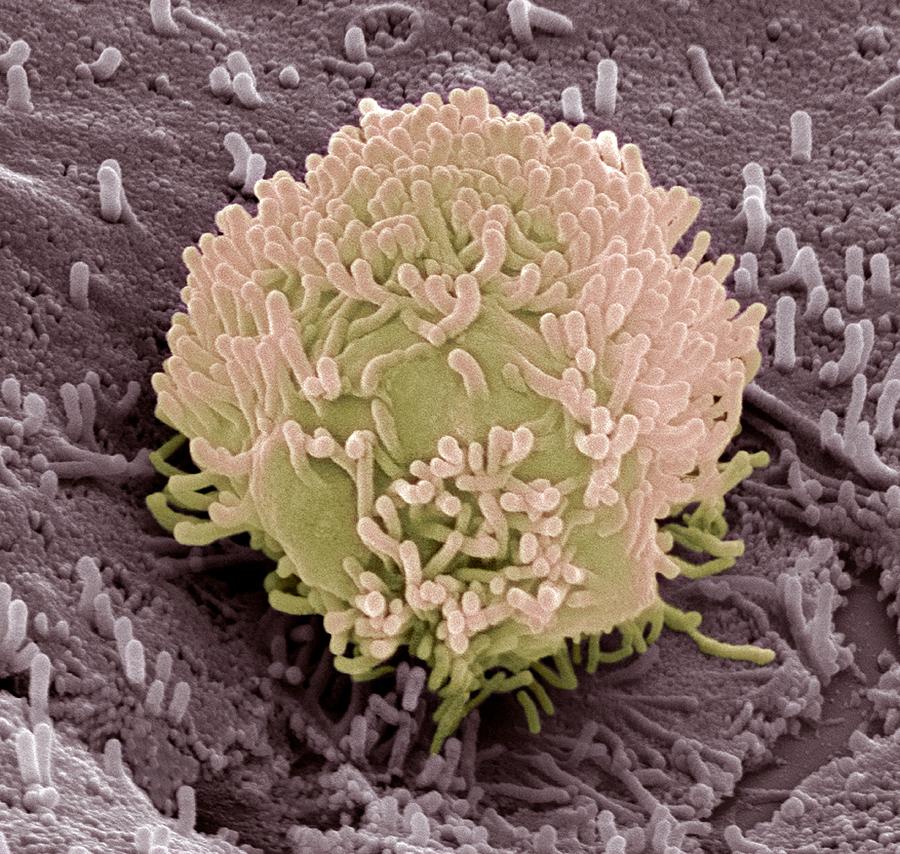 Cancer Photograph - Colorectal Cancer Cell #1 by Steve Gschmeissner