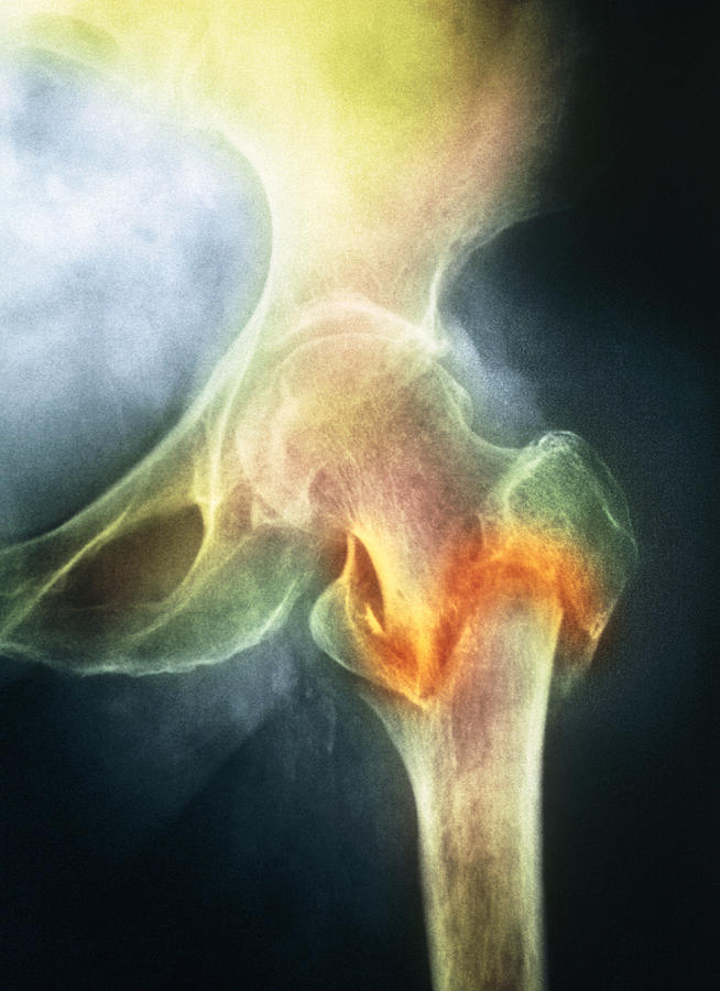 Osteoporosis Photograph - Coloured X-ray Of Femur Fracture In Osteoporosis #1 by Medical Photo Nhs Lothian