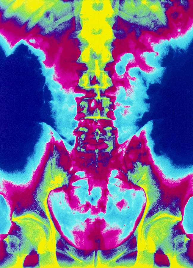 Skeleton Photograph - Coloured X-ray Of Normal Lumbar Spine (lower Back) #1 by Mehau Kulyk