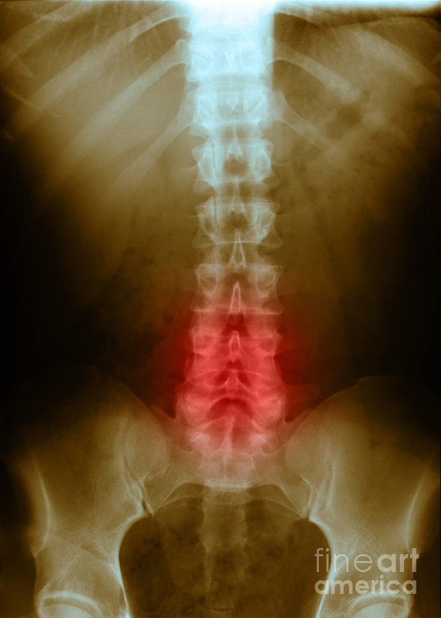 X Ray Photograph - Compression In Lumbar Vertebrae #1 by Science Source