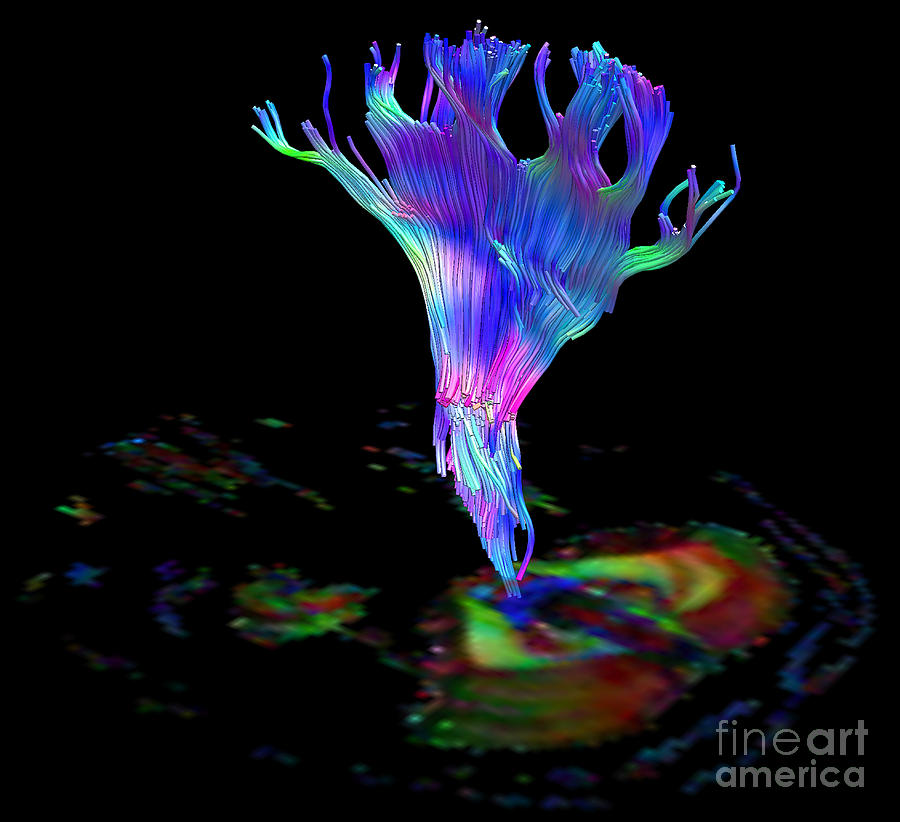 Brain Mri Photograph - Corona Radiata, Diffuse Tensor Imaging #1 by Living Art Enterprises