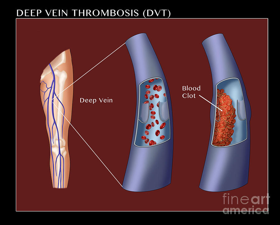 deep vein thrombosis