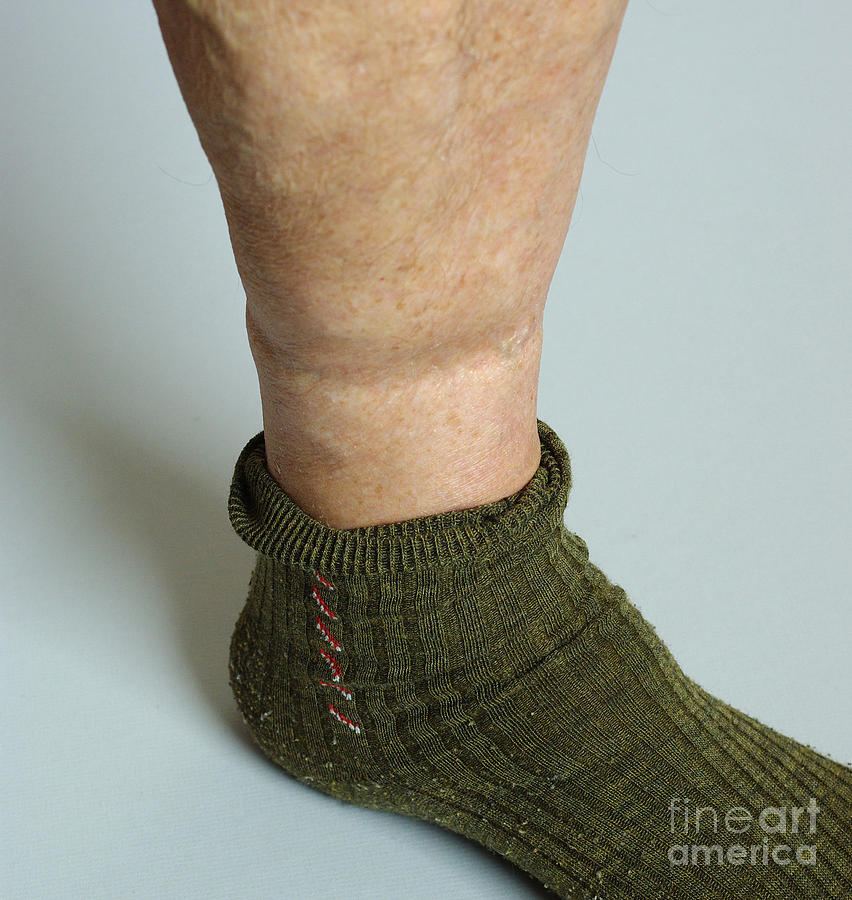 Elastic In Socks Impairs Blood Flow #1 Photograph by Scimat