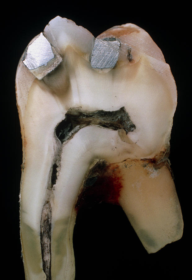 Extracted Molar #1 Photograph by Dr Jeremy Burgess