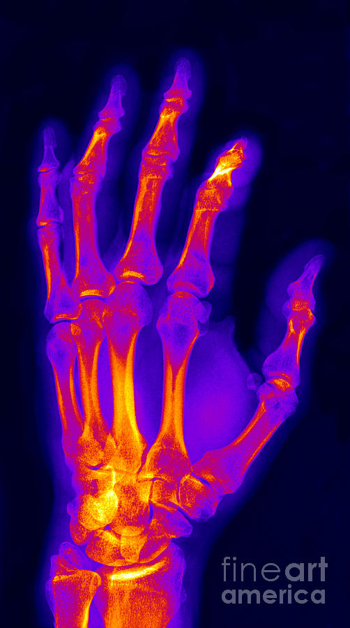 Finger Fracture #1 Photograph by Ted Kinsman