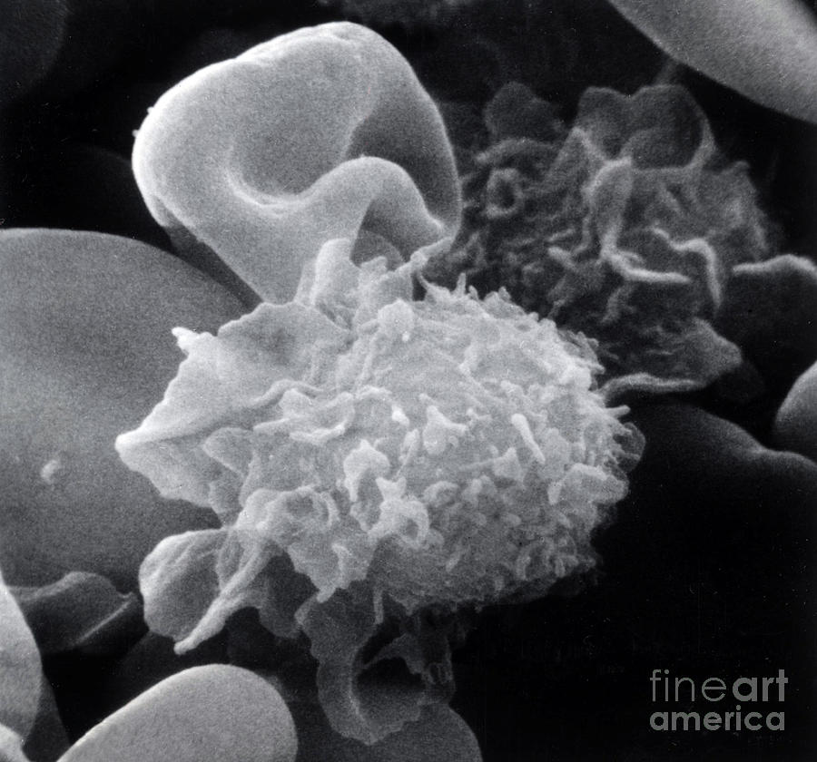 Science Photograph - Hairy Cell Leukemia, Sem #1 by Science Source