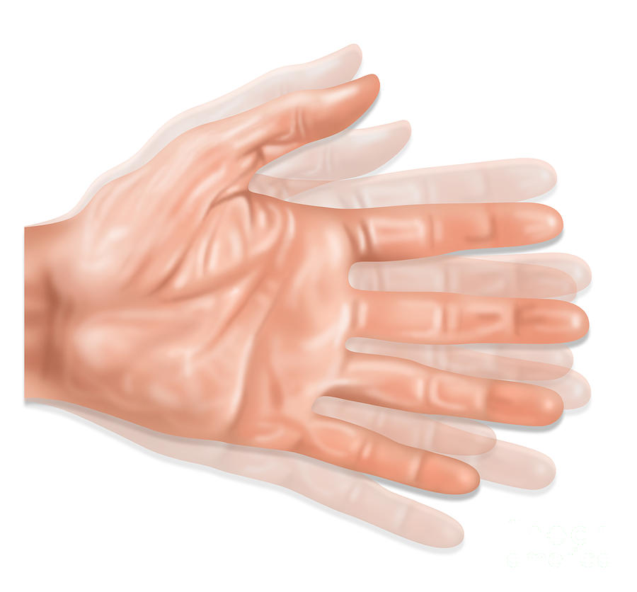 Hand Tremors, Illustration #1 Photograph by Gwen Shockey