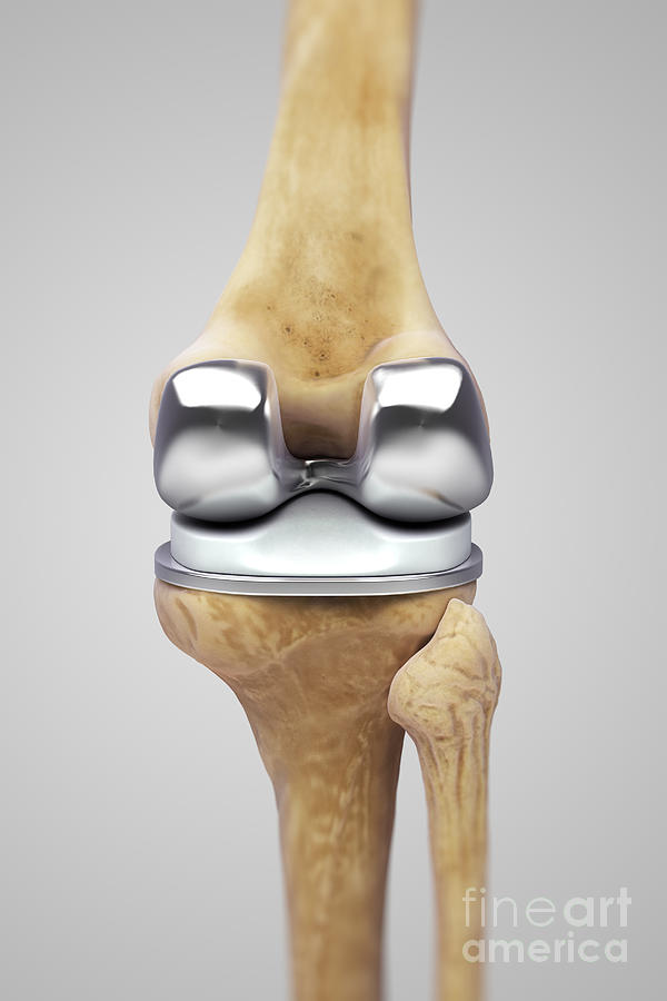 Knee Replacement #1 Photograph by Science Picture Co
