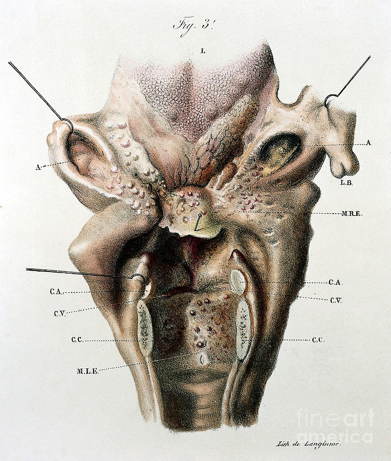 Larynx, Pathology, Illustration, 19th #1 Photograph by Wellcome Images