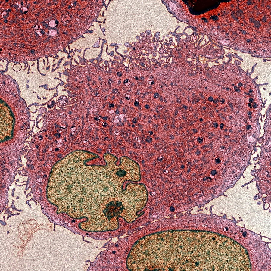 Disease Photograph - Leukaemia Cells, Tem #1 by Steve Gschmeissner