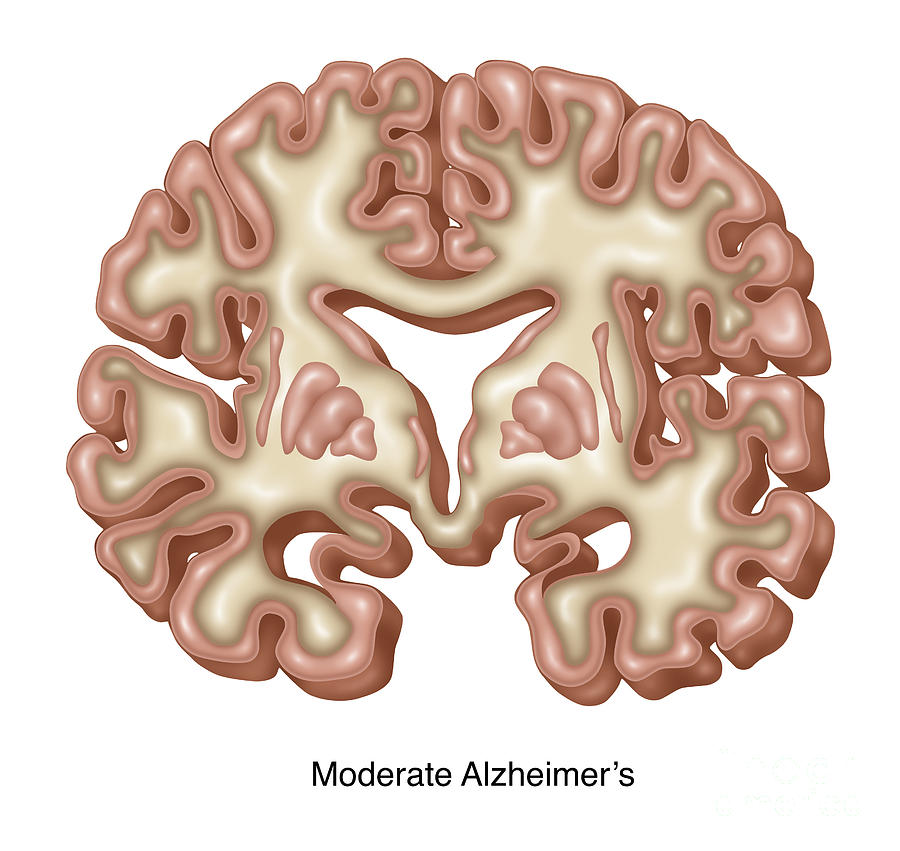 Moderate Alzheimers Brain, Illustration #1 Photograph by Gwen Shockey