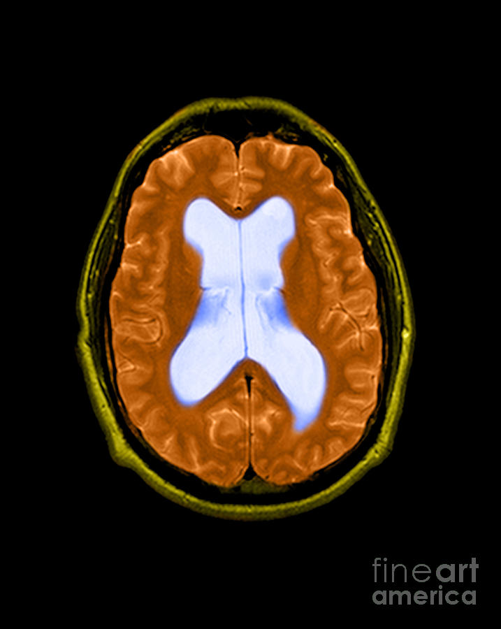 Abnormal Mri Of Brain Photograph - Mri Communicating Hydrocephalus Nph #1 by Medical Body Scans