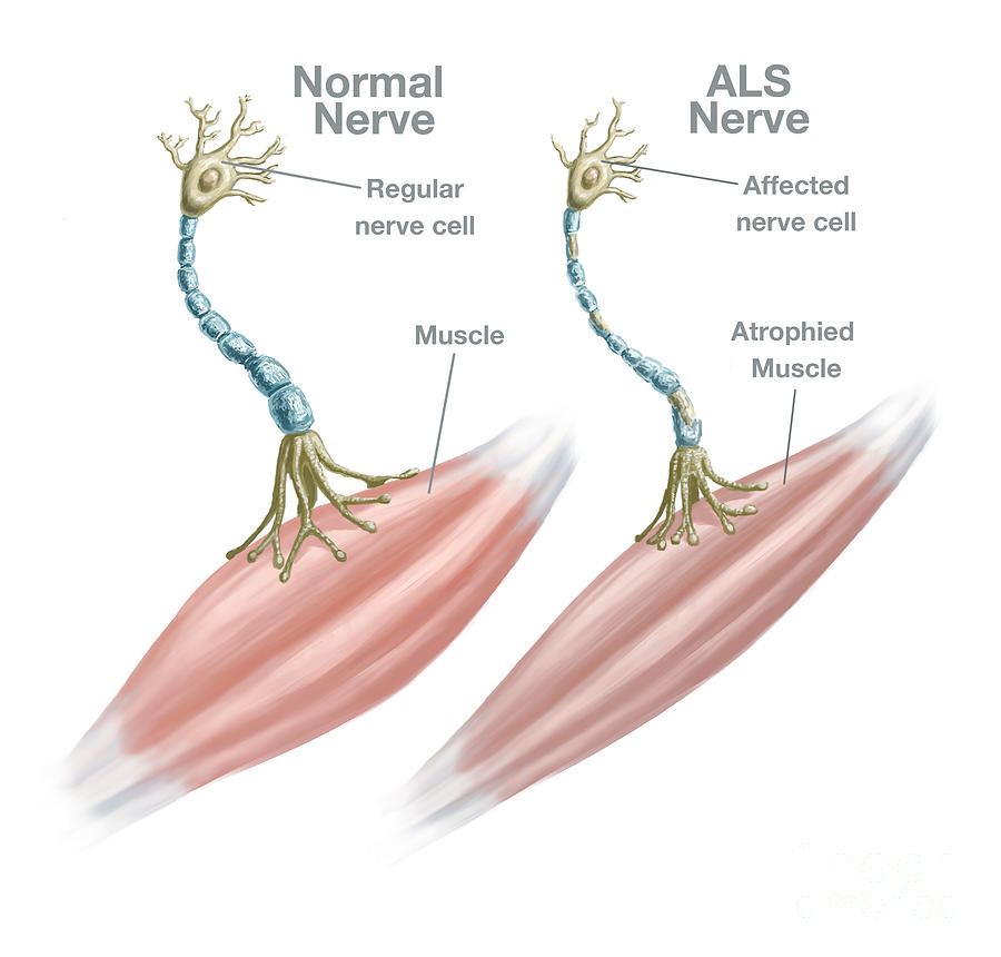 Normal Nerve And Als Nerve Photograph by Spencer Sutton