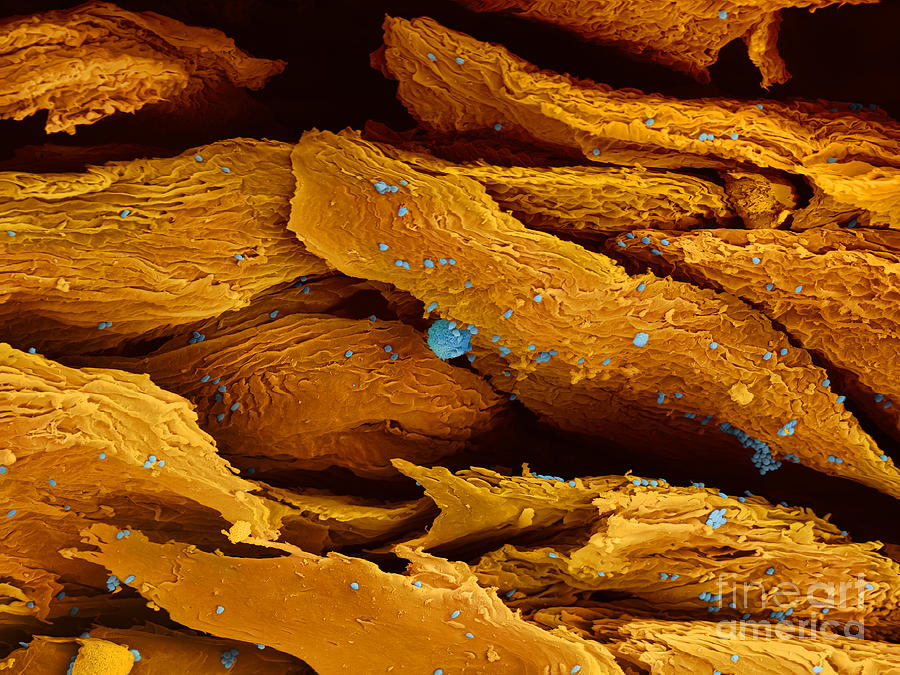 Skin Cancer, Sem #1 Photograph by Ted Kinsman