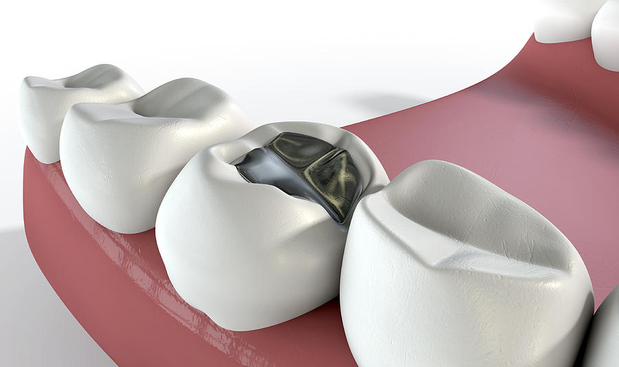 Teeth Digital Art - Teeth With Lead Filling #1 by Allan Swart
