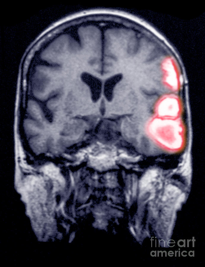 Temporoparietal Brain Hemorrhage, Mri #1 Photograph by Scott Camazine