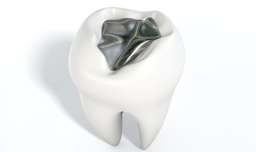 Teeth Digital Art - Tooth With Lead Filling #1 by Allan Swart