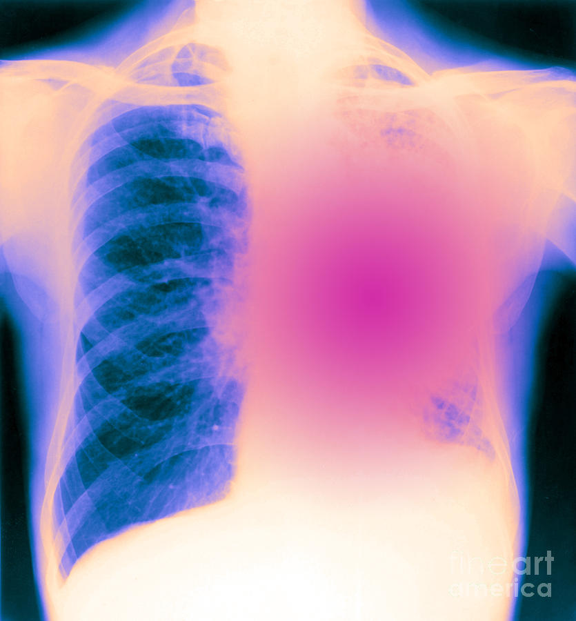 X-ray Of Bronchial Carcinoma #1 Photograph by Biophoto Associates