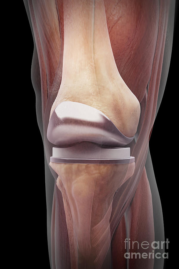 Knee Replacement #10 Photograph by Science Picture Co