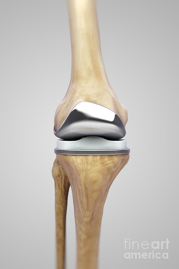 Knee Replacement #11 Photograph by Science Picture Co