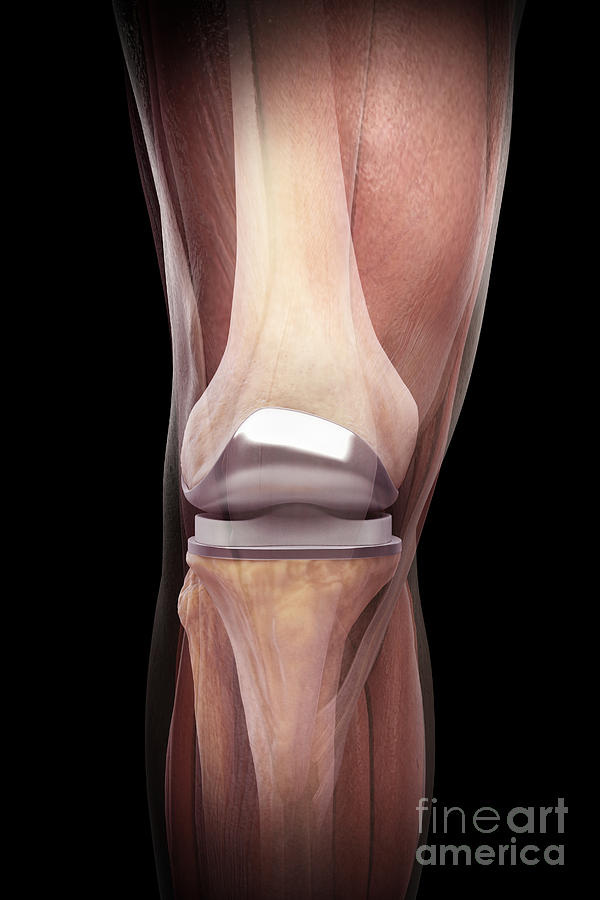 Knee Replacement #12 Photograph by Science Picture Co