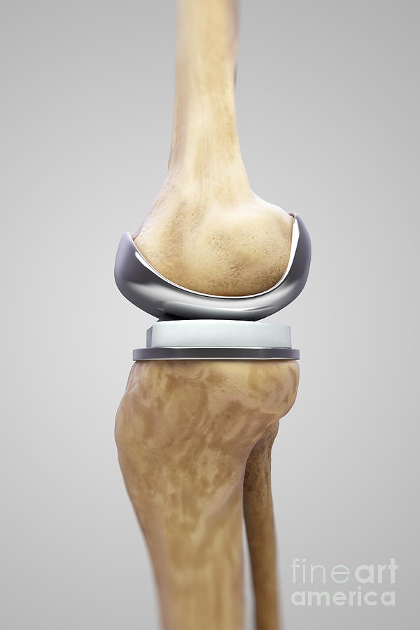 Knee Replacement #13 Photograph by Science Picture Co