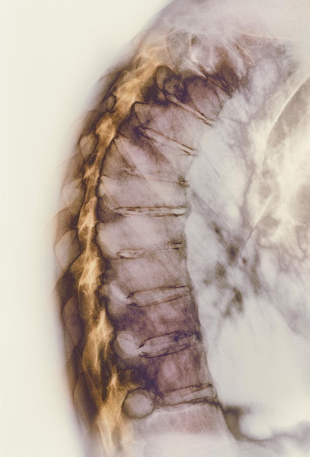 Spine Photograph - Ankylosing Spondylitis X-ray #2 by Cnri