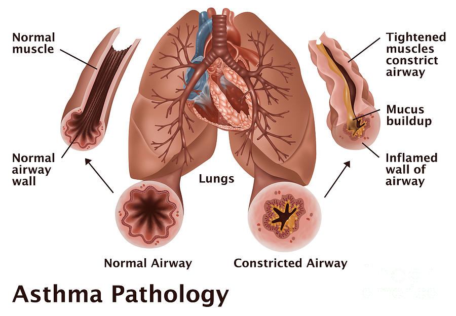Asthma Pathology #2 Photograph by Gwen Shockey
