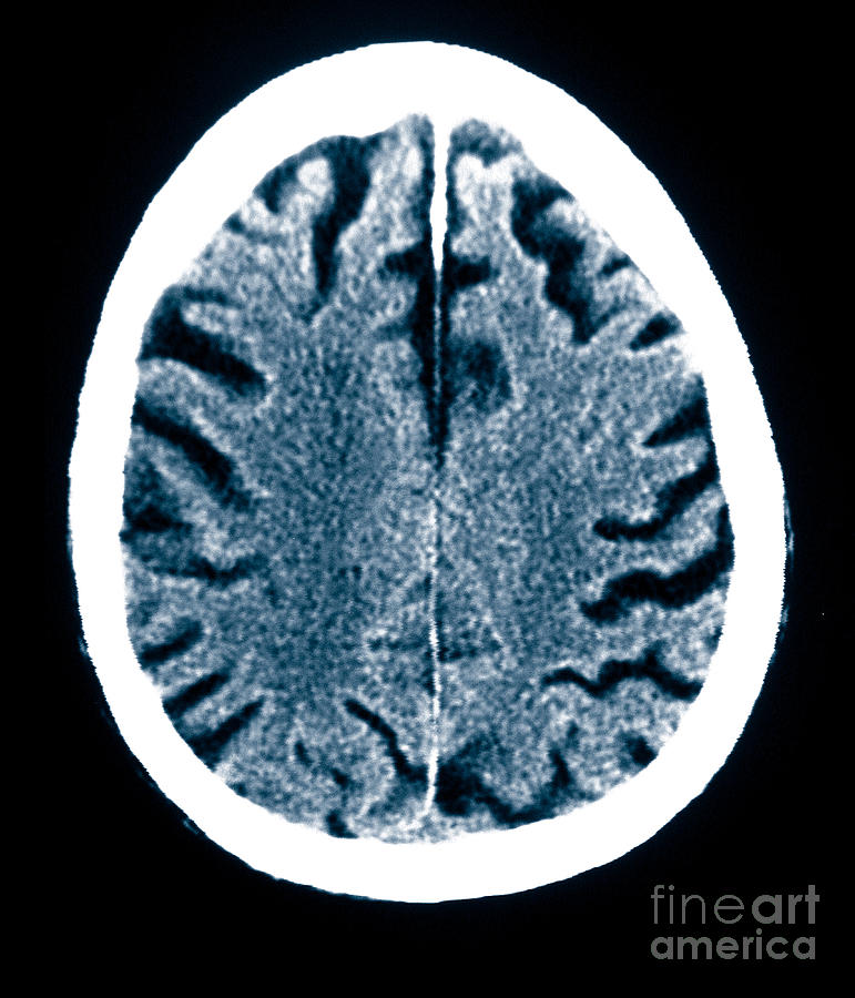 Brain Of Alzheimers Patient Ct Scan 2 Photograph By Scott Camazine