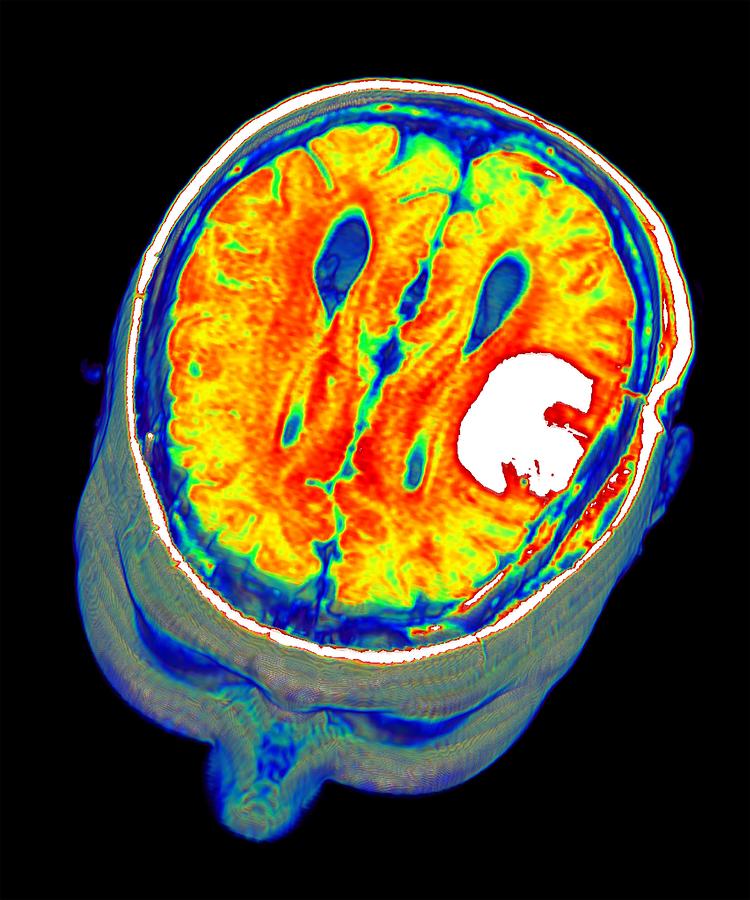 3 Dimensional Photograph - Brain Tumour, 3d-mri Scan #2 by Pasieka