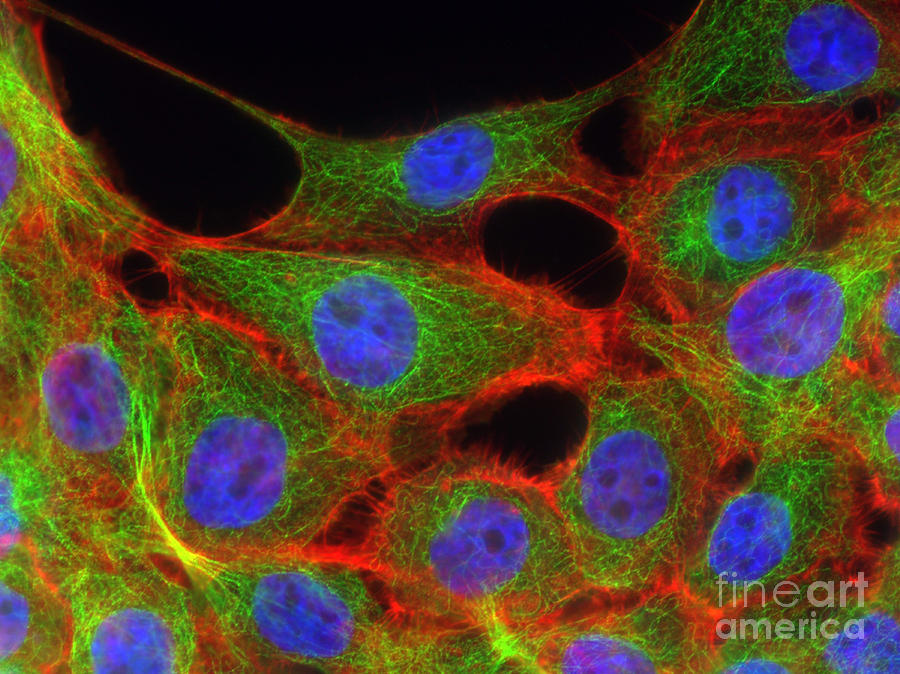 Breast Cancer Cells, Fm #2 Photograph by Science Source