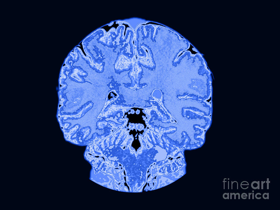 Coronal View Mri Of Normal Brain #2 Photograph by Medical Body Scans