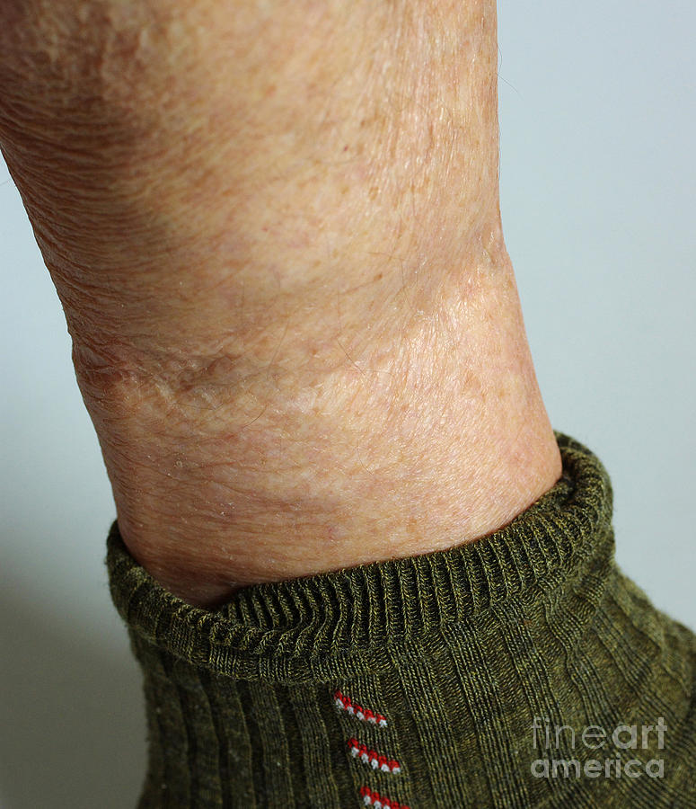 Elastic In Socks Impairs Blood Flow #2 Photograph by Scimat