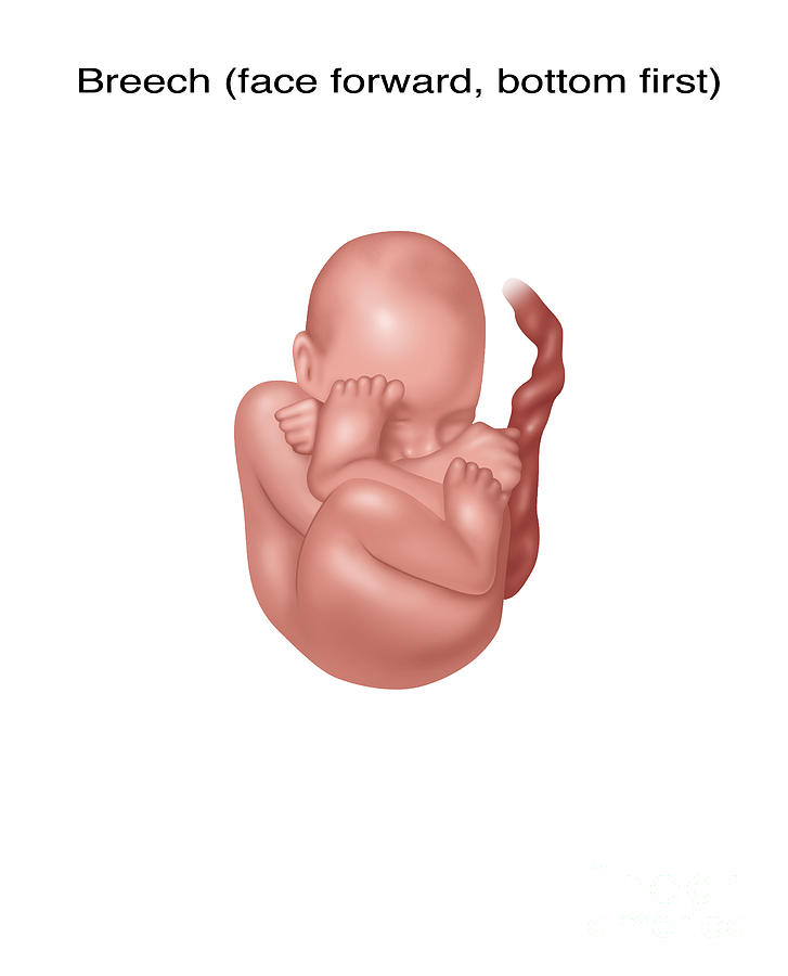 breech presentation fetus 1