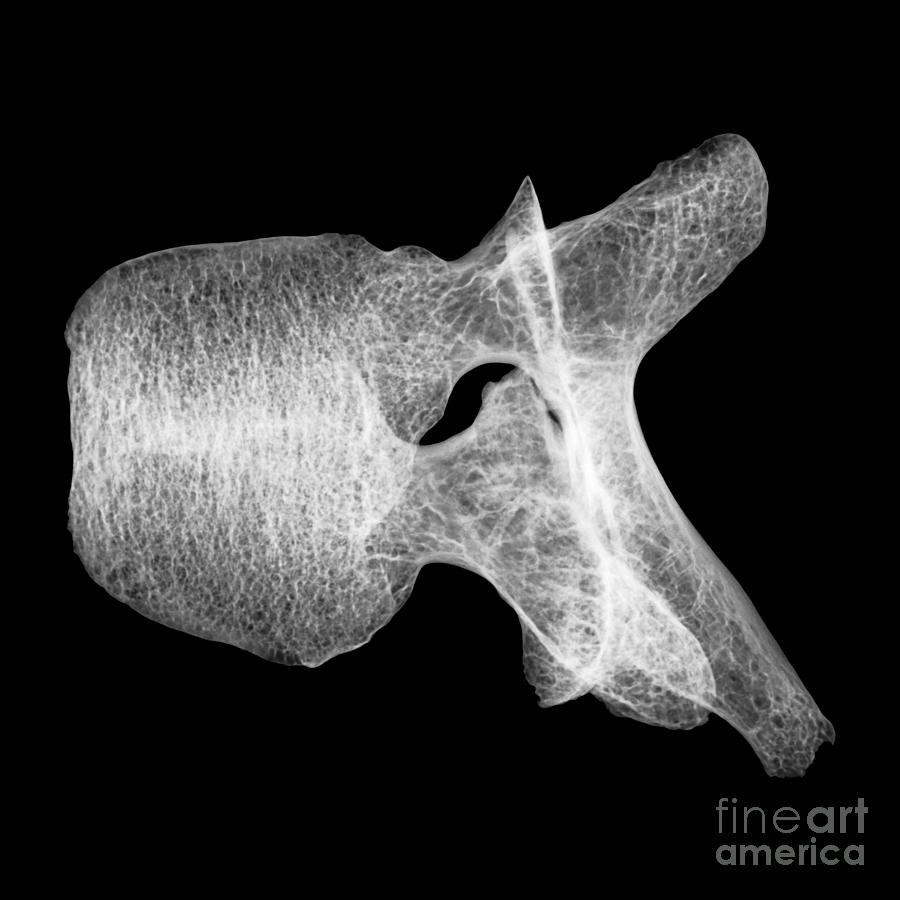Human Vertebra T5, X-ray #2 Photograph by Ted Kinsman