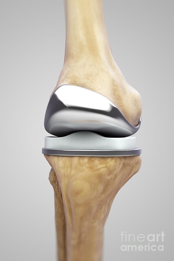 Knee Replacement #2 Photograph by Science Picture Co