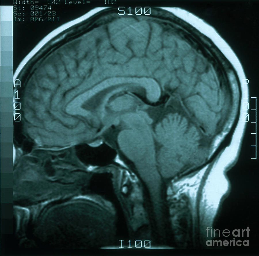 Mri Of Normal Brain Photograph by Science Source
