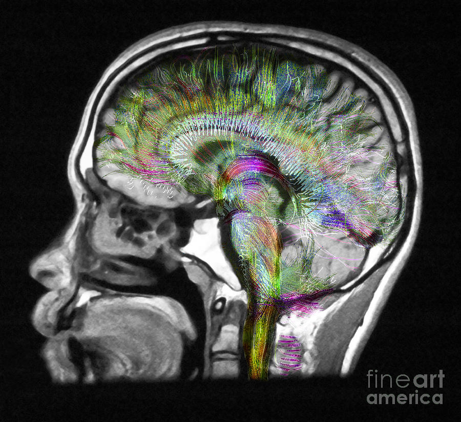 Normal Brain, Fiber Tractography And Mri #2 Photograph by Scott Camazine
