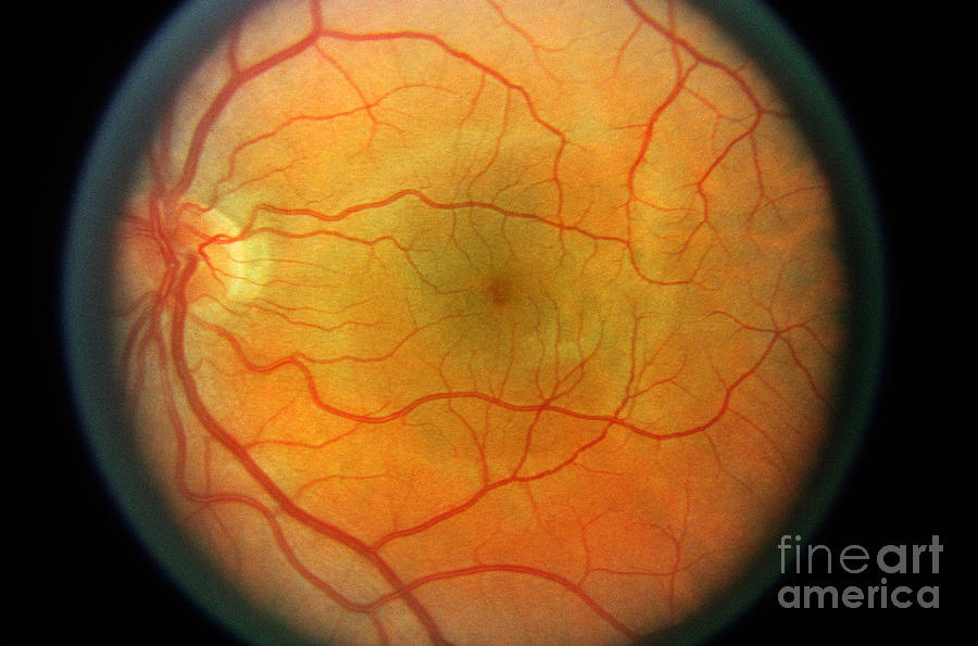 Normal Retina #2 Photograph by Science Source