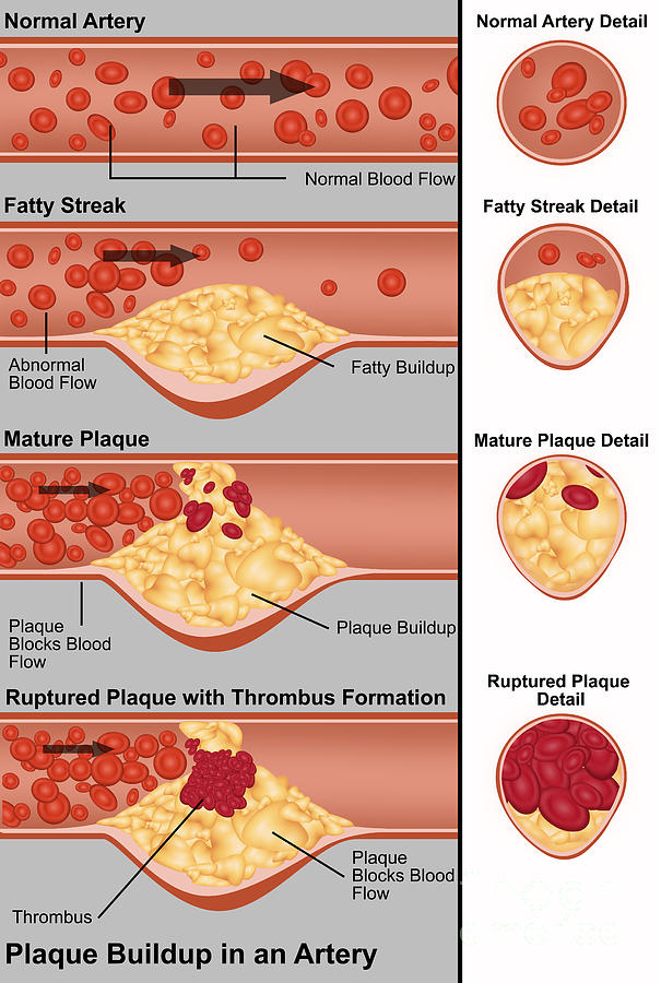 What Is Plaque In Arteries