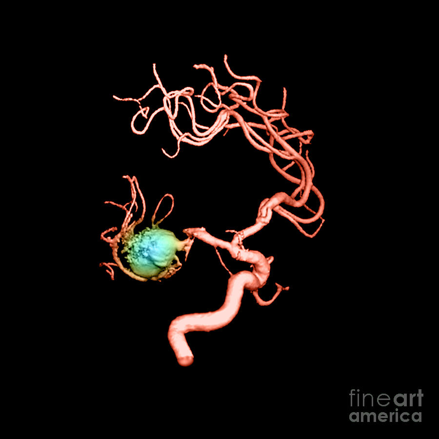 3-d Imagery Photograph - Aneurysm In The Human Brain #3 by Medical Body Scans