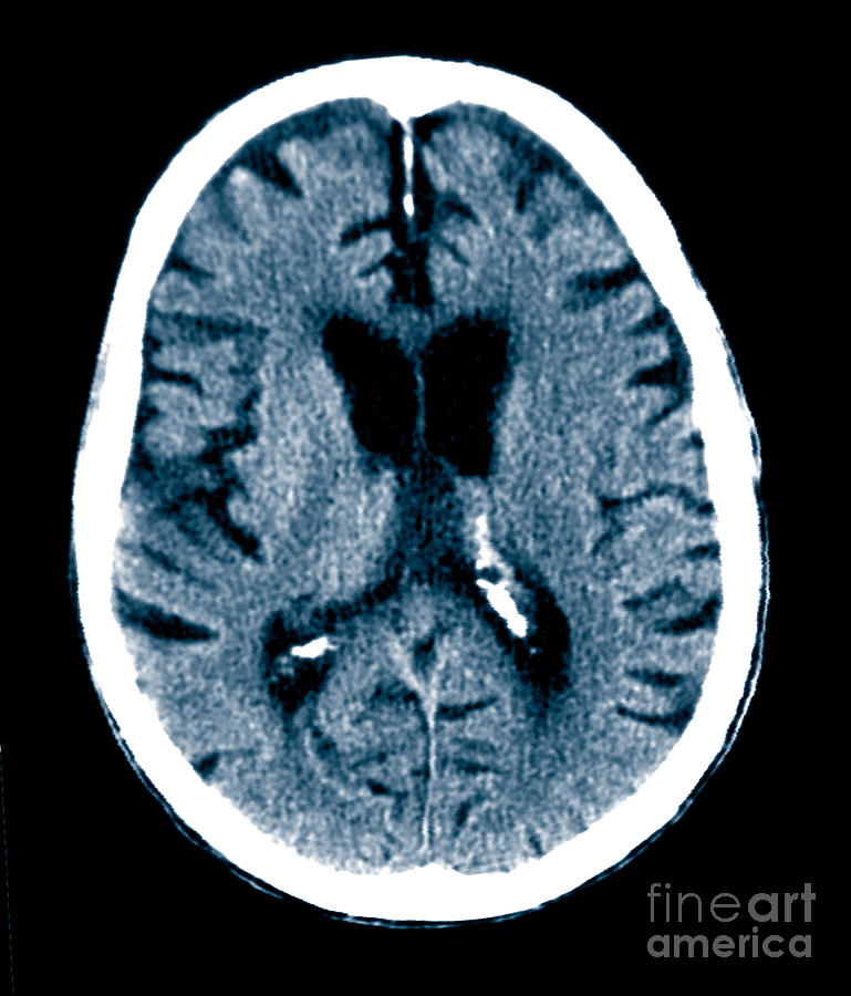Brain Of Alzheimers Patient Ct Scan Photograph By Scott Camazine