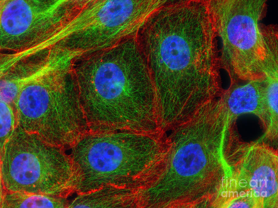 Breast Cancer Cells, Fm #1 Photograph by Science Source
