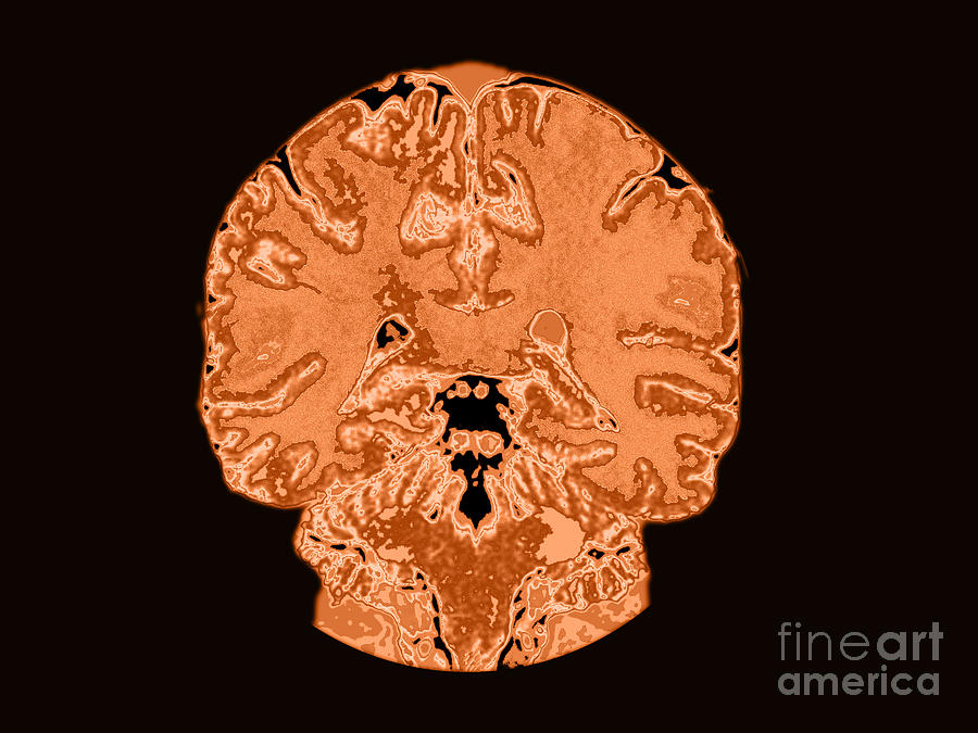 Coronal View Mri Of Normal Brain #3  by Medical Body Scans