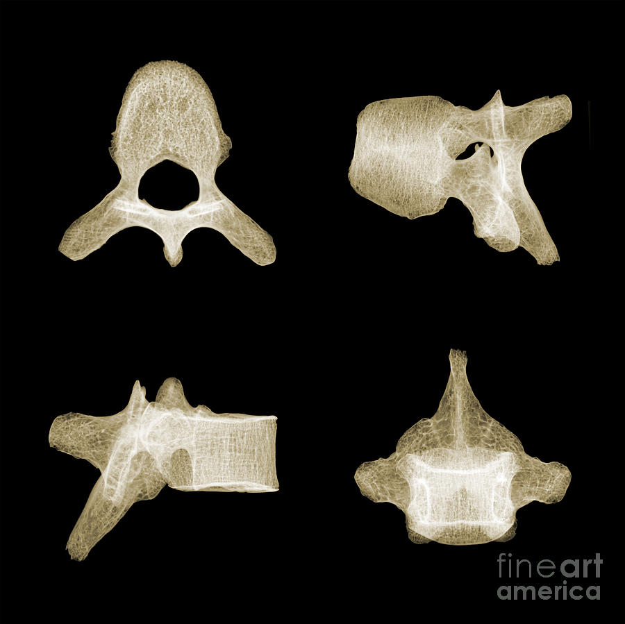 Human Vertebra T5, X-ray #3 Photograph by Ted Kinsman