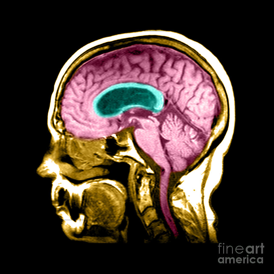 Brain Photograph - Hydrocephalus #3 by Medical Body Scans