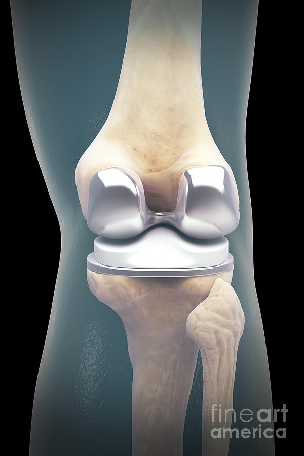 Knee Replacement #3 Photograph by Science Picture Co