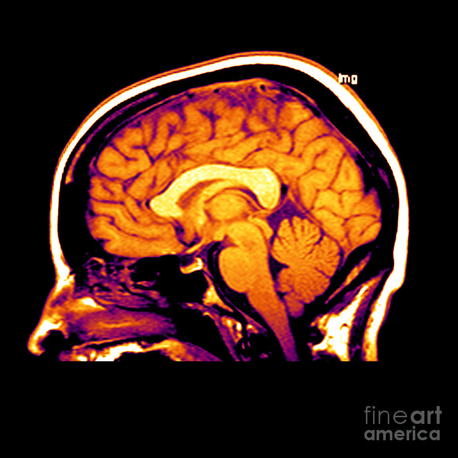 Brain Photograph - Mri Of Brain #3 by Medical Body Scans