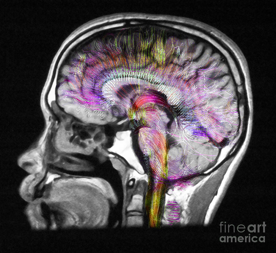 Normal Brain, Fiber Tractography And Mri #3 Photograph by Scott Camazine