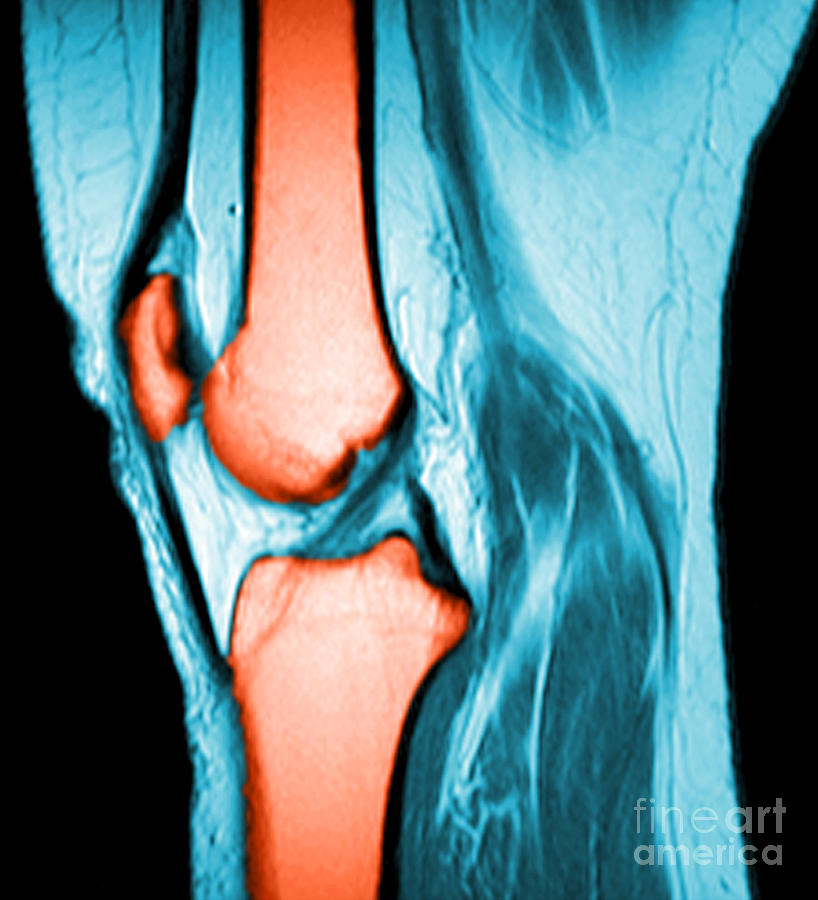 Normal Knee #3 Photograph by Medical Body Scans